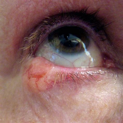 Lump On Eyelid Cancer