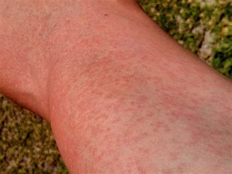 Rash On The Wrist Causes Diagnosis And Treatment