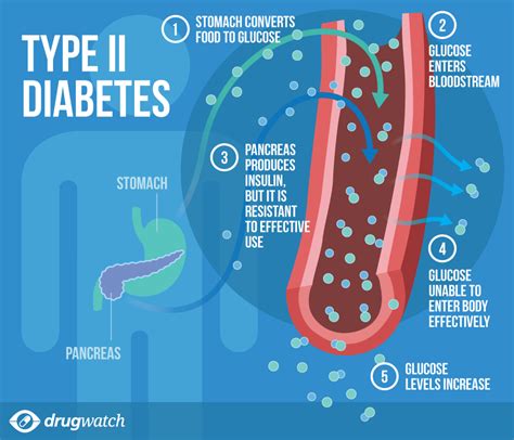 Diabetes - Symptoms, Diagnosis, Treatments & Complications