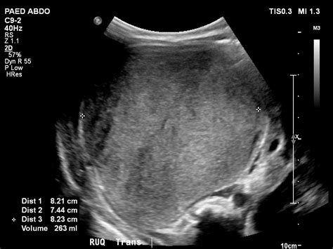 Wilms Tumor Image