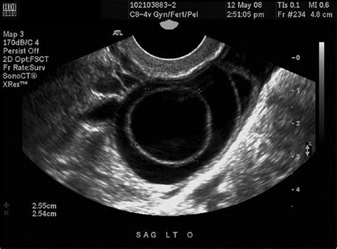 Stage 4 Ovarian Cancer Ultrasound Cancerwalls