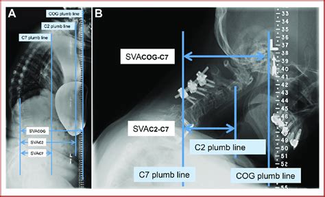 Radiographic Parameters Based On The Distance To The Sagittal Vertical