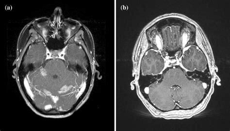 Axial Slice Of T1 Weighted Mri With Contrast Following A Diagnosis Of