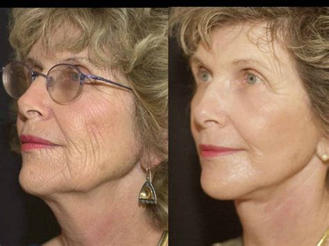 Full Face Laser Facial Treatment Before After Gainesville Face Lift