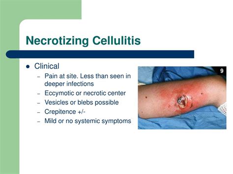 Ppt Soft Tissue Infections Powerpoint Presentation Free Download