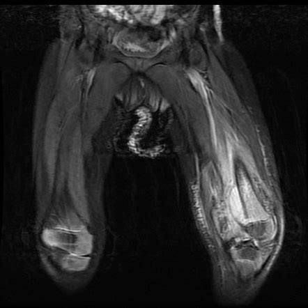 Subperiosteal Abscess Radiology Reference Article Radiopaedia Org