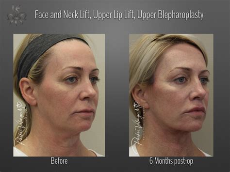 Facelift And Neck Lift Case 4378 New Orleans Premier Center For Aesthetics And Plastic Surgery