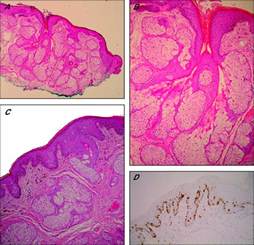 sebaceous hyperplasia of the vulva a clinicopathological case report with a review of the