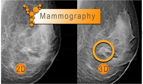 3d Mammography Or Tomosynthesis Ygeia Iatriki Apeikonisi