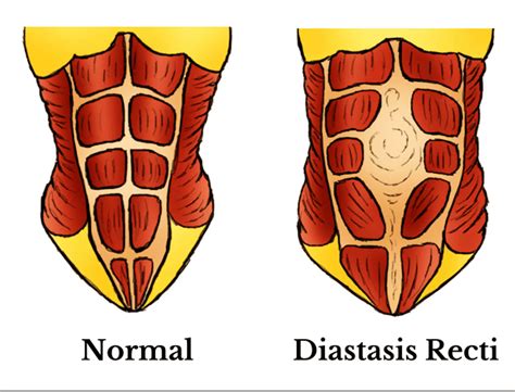 Diastasis Recti Whats Really Important Institute For Birth Healing