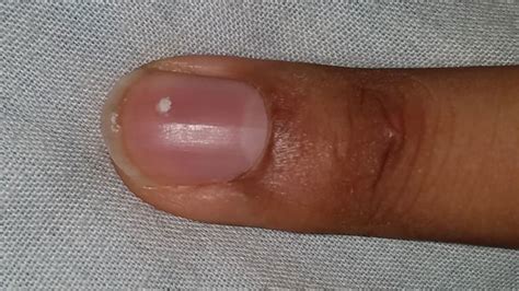 What Causes White Spots On Fingernails Learnskin