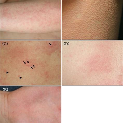 Clinical Photographs Of Cholinergic Urticaria A Typical