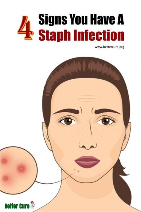 4 Signs You Have A Staph Infection Staph Infection Staph Infection