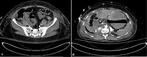 Axial Enhanced Ct Scan Of The Abdomen Shows Extensive Pneumatosis
