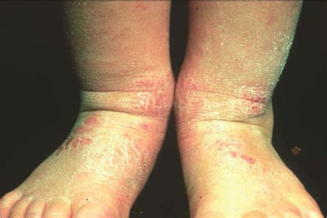 Advances In Atopic Dermatitis Rcp Journals