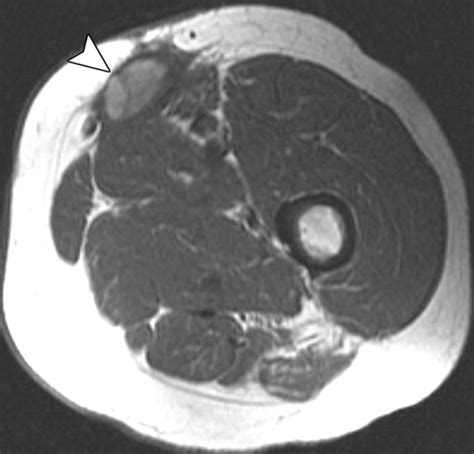 Soft Tissue Tumors And Tumorlike Lesions A Systematic Imaging Approach