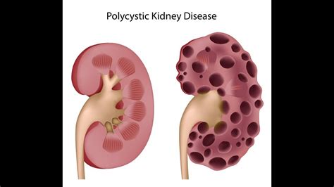 Polycystic Kidney Disease Youtube