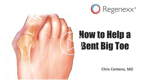Big Toe Bent To The Side Heres How To Help Regenexx Blog