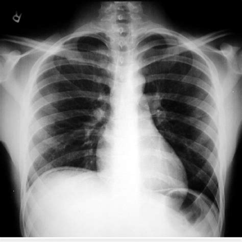 X Ray Chest Showing Free Gas Under Right Hemidiaphragm Download