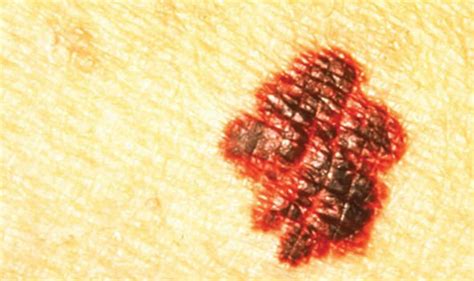 Skin Cancer Symptoms The Alphabetical Signs Of An Aggressive Melanoma