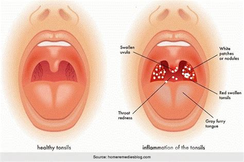 White Pustules In Throat Mature Teen Tube