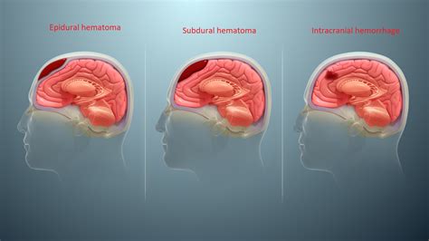 Craniotomia Para Drenagem De Hematoma Subdural Ensino