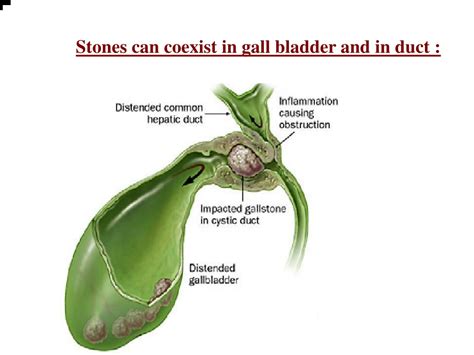 Ppt Gall Stones And Management Powerpoint Presentation Free Download Id
