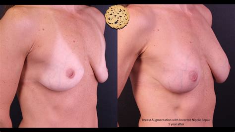 Inverted Nipple Correction Gallery Plastic Surgery