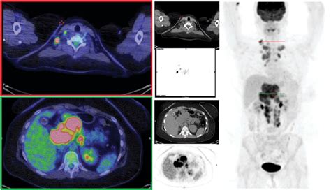 Positron Emission Tomographycomputed Tomography Imaging With