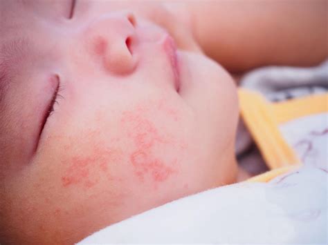 What Are The Different Types Of Baby Allergies Allergies Hub