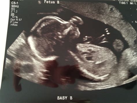 無料ダウンロード 24 Weeks Pregnant With Twins Ultrasound 485923 24 Weeks