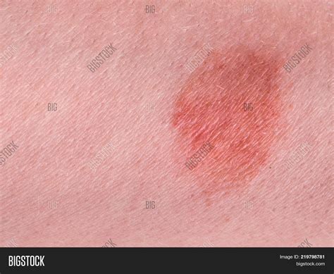 Great Red Spot On Skin Image And Photo Free Trial Bigstock