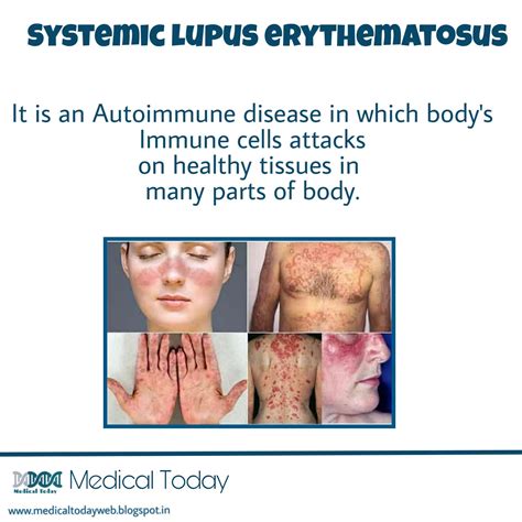 Systemic Lupus Erythematosus Sle Lupus Systemic Erythematosus Sle