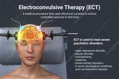 Electroconvulsive Therapy Illustration Stock Image F0376812