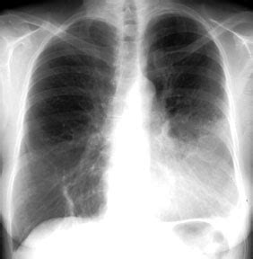 9:18 stages of lobar pneumonia 11:56 red hepatization 15:54 grey hepatization 18:35 resolution what is pneumonia types. Bronchopneumonia Vs Lobar Pneumonia Cxr - bronchitis ...