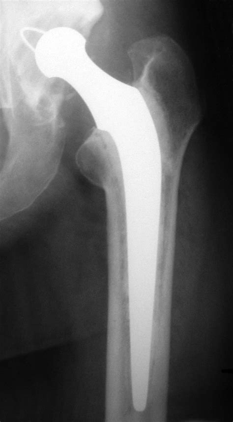 Charnley Low Friction Arthroplasty Of The Hip Five To 25 Years