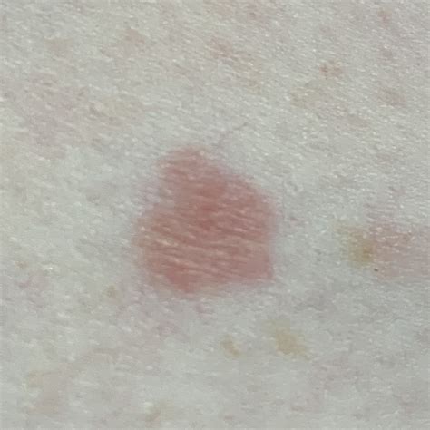 Lichenoid Keratosis Spot Check Skin Cancer Aesthetics Melbourne Cbd