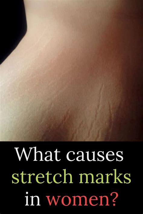 Pin By Crissudhz On Skin Care Stretch Marks What Causes Stretch