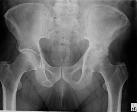 Paget disease of bone | Image | Radiopaedia.org