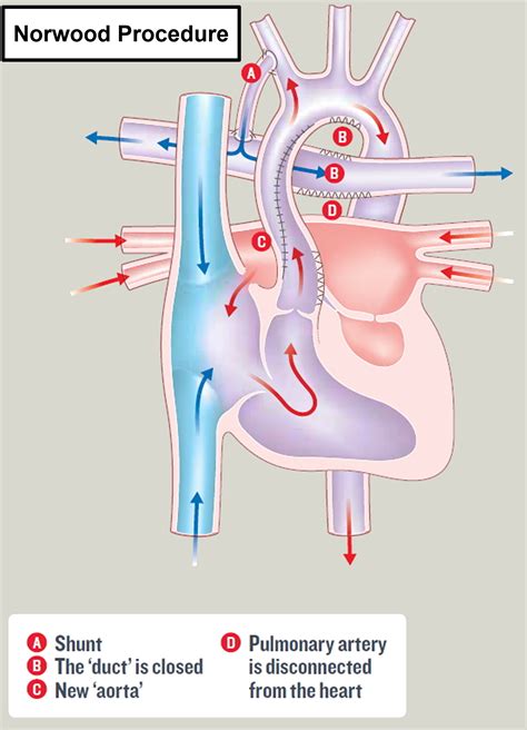 Hypoplastic Left Heart Syndrome Causes Prognosis Surgery Treatment