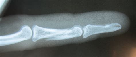Less Invasive Finger Fracture Treatment John Erickson Md
