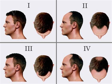 Does the hair you leave in the shower, on your comb, or on your pillow. Norwood Scale Hair Loss Stage - Mono