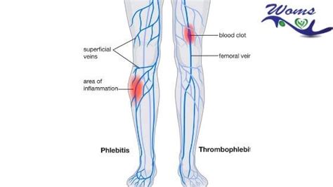 How To Know If You Have Phlebitis A Guide To Signs And
