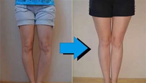 Curved Legs Turn Into Straight Legs It Turns Out People Have Suffered