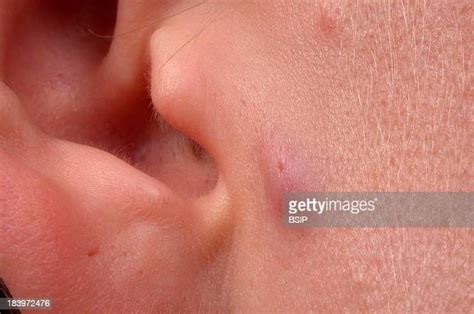 Sebaceous Cyst Foto E Immagini Stock Getty Images