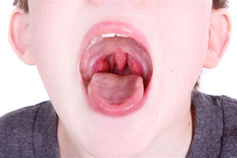 Important Warning Signs Of Strep Throat Childhood