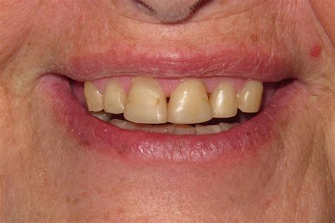 Removable Partial Denture Before And After