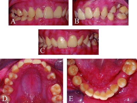 Intraoral Examination Right Occlusion A Left Occlusion B