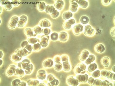 Your lungs are a pair of organs in your chest. Morgellons Disease Awareness - Live blood microscopy in a person suffering from Morgellons ...