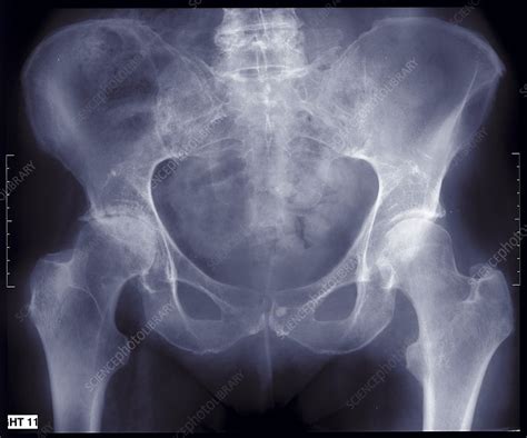 Human Pelvis X Ray Stock Image F0299439 Science Photo Library